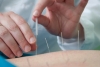 Châm cứu là một liệu pháp chữa bệnh độc đáo.
