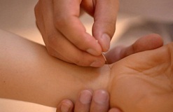 Châm cứu & bấm huyệt trị ốm nghén