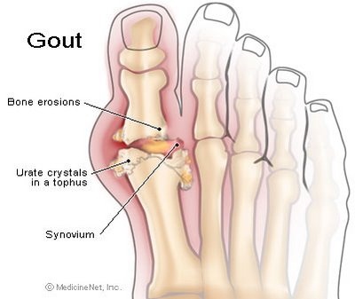 BỆNH GOUT