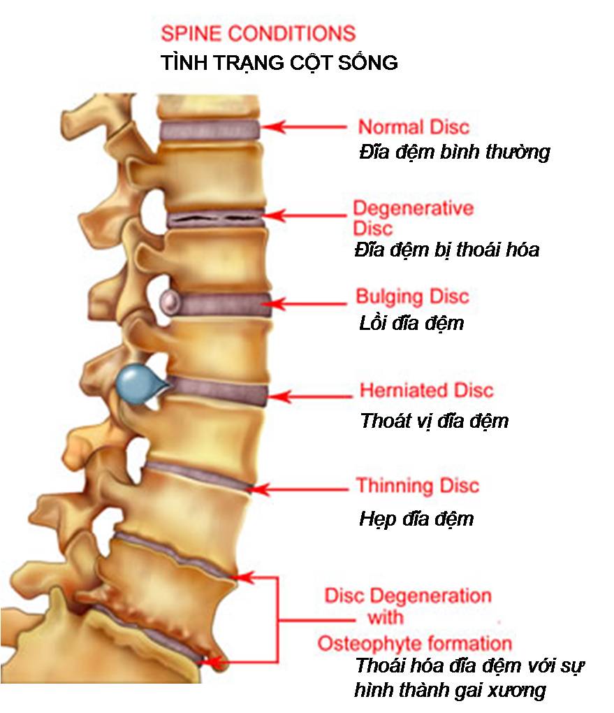 BỆNH GAI CỘT SỐNG