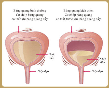 VIÊM BÀNG QUANG