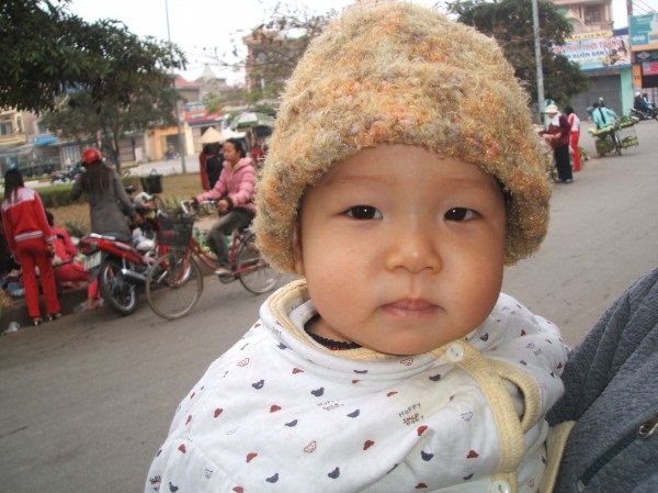 MẮT KHÔ CỦA TRẺ EM SUY DINH DƯỠNG