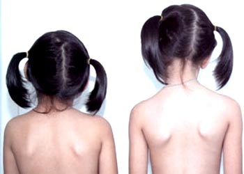 CỔ VẸO