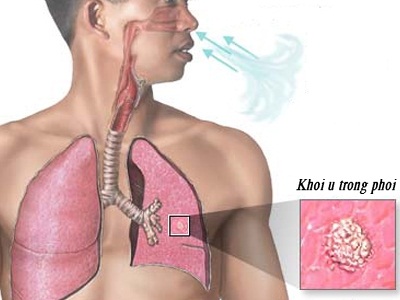 LAO PHỔI