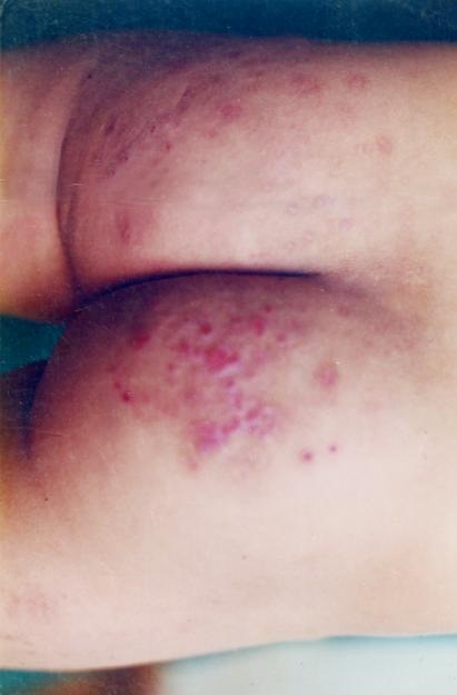 Herpes