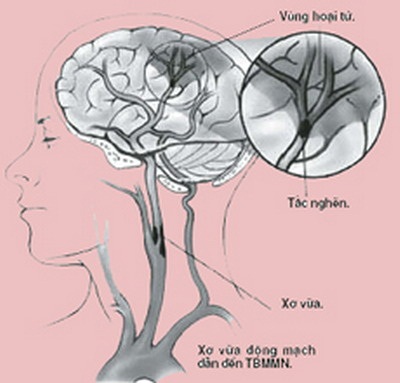 THIỂU NĂNG TUẦN HOÀN NÃO